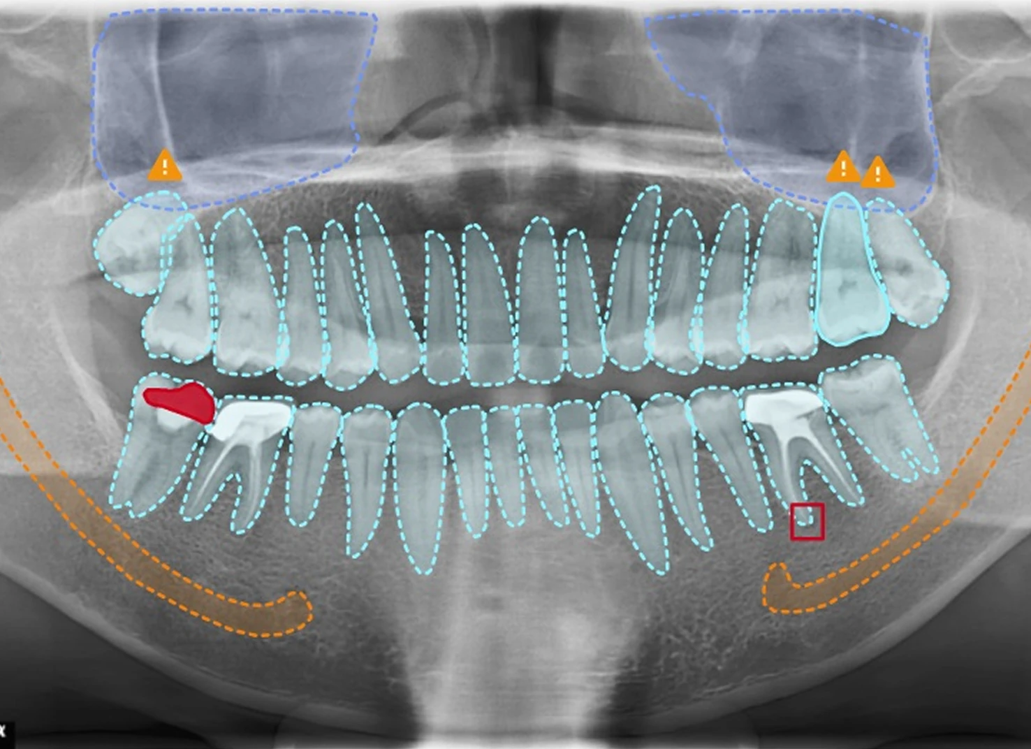 Phan tich X-Ray nha khoa